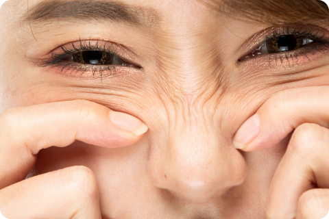 Nasenfältchen ("Bunny lines") - Botulinumtoxin (z.B. Botox®)