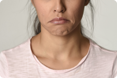Kinnfalten ("Erdbeerkinn") - Botulinumtoxin (z.B. Botox®)