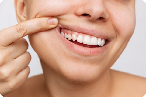 Zahnfleischlächeln ("Gummy smile") - Botulinumtoxin (z.B. Botox®)