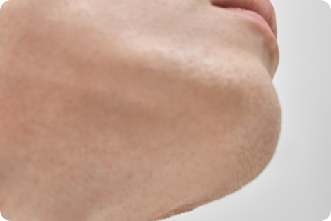 Kinnaufbau - Calcium-Hydroxylapatit (Radiesse®)