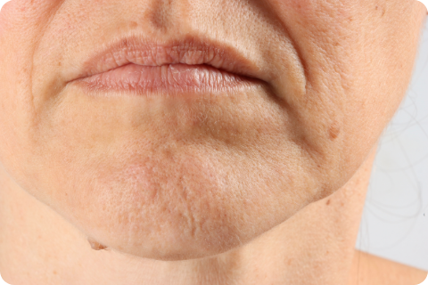Marionettenfalten - Botulinumtoxin (z.B. Botox®)