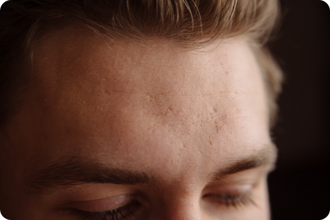 Narben (Gesicht - Stirn) - PRP (Platelet-Rich Plasma/Eigenblut)
