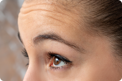 Stirnfalten - Botulinumtoxin (z.B. Botox®)