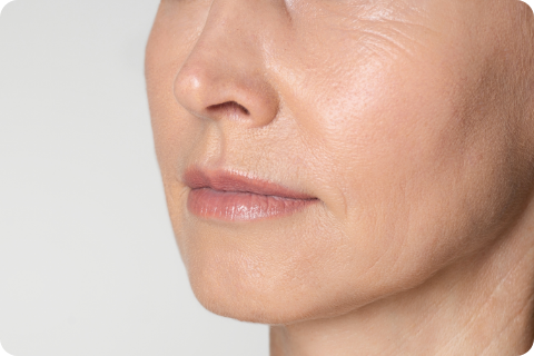 Wangenverjüngung - PRP (Platelet-Rich Plasma/Eigenblut)